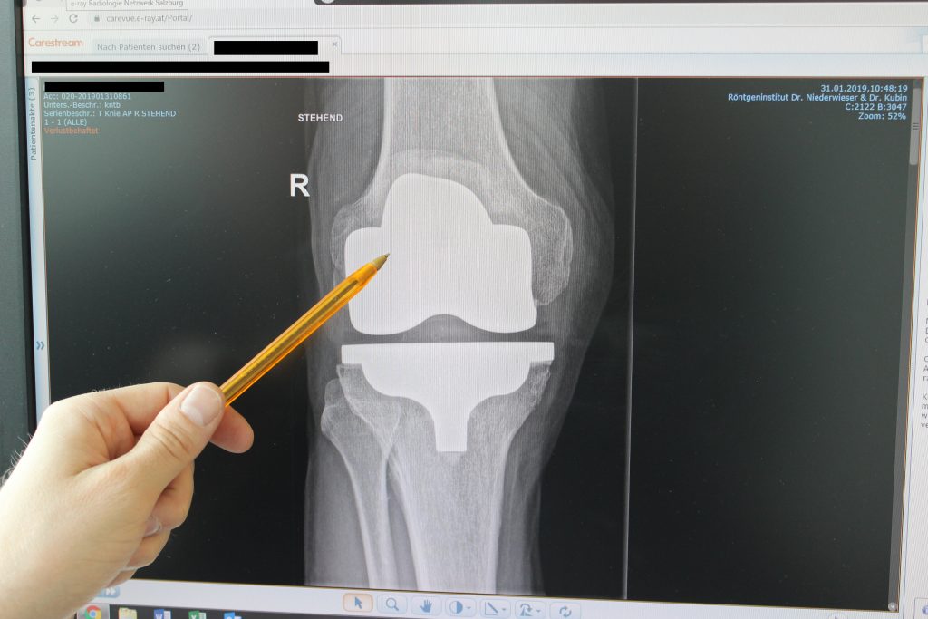 Knieprothesen Und Hüftprothesen - Sportmed Plus